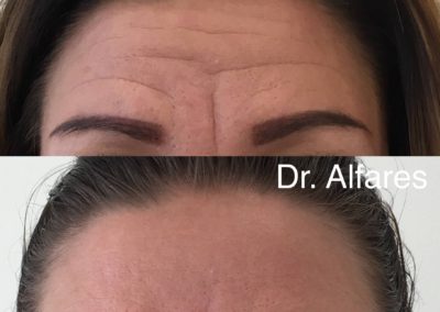 Botulotoxín (Botox)