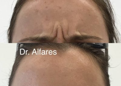 Botulotoxín (Botox)