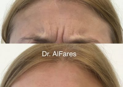 Botulotoxín (Botox)