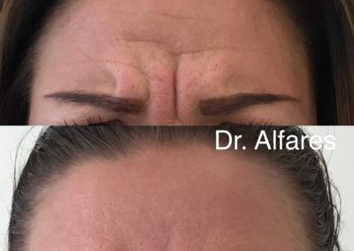 Botulotoxín (Botox)