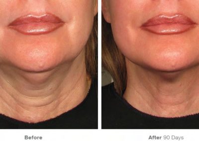 ultherapy-final-28