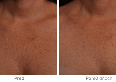 ultherapy-final-31b