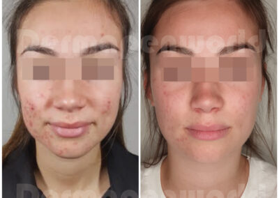 Acne_Female 9