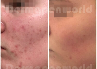 Acne_Male 1
