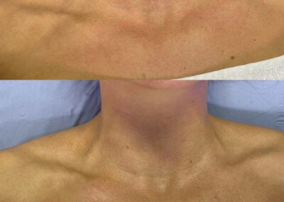 Epicutis Before & After