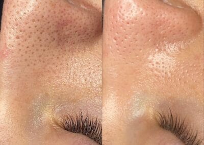Instagram Grid Blackhead Before _ After Treatment Image