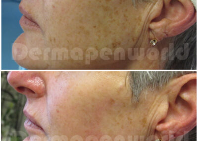 Pigmentation_Female 2