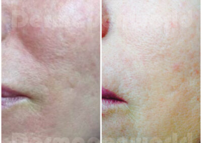 Rosacea_Female 5