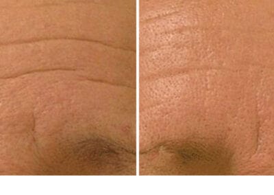 hydrafacial-before-after-lines-wrinkles